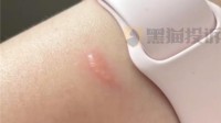 女子戴Apple Watch睡觉被烫伤起泡 苹果客服：是过敏